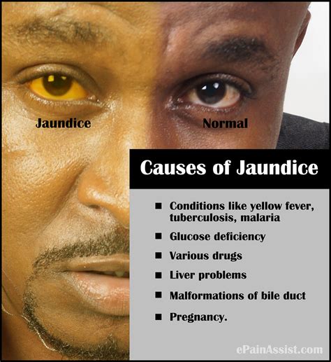 Jaundice .